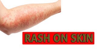 Cure Rash Naturally | How to Get Rid of a Rash Fast At Home