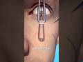 Tooth In Eye Surgery 😨 Surgeon Reacts