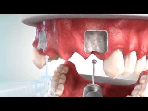 download lagu mp3 mp4 Dental Implants Whitby, download lagu Dental Implants Whitby gratis, unduh video klip Dental Implants Whitby