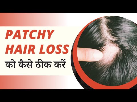 Patchy Hair Loss को कैसे ठीक करें | Patchy Hair Loss Treatment | Alopecia Areata Treatment |