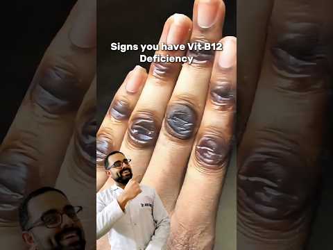 Signs you have Vit B12 Deficiency #b12 #vitamin #deficiency