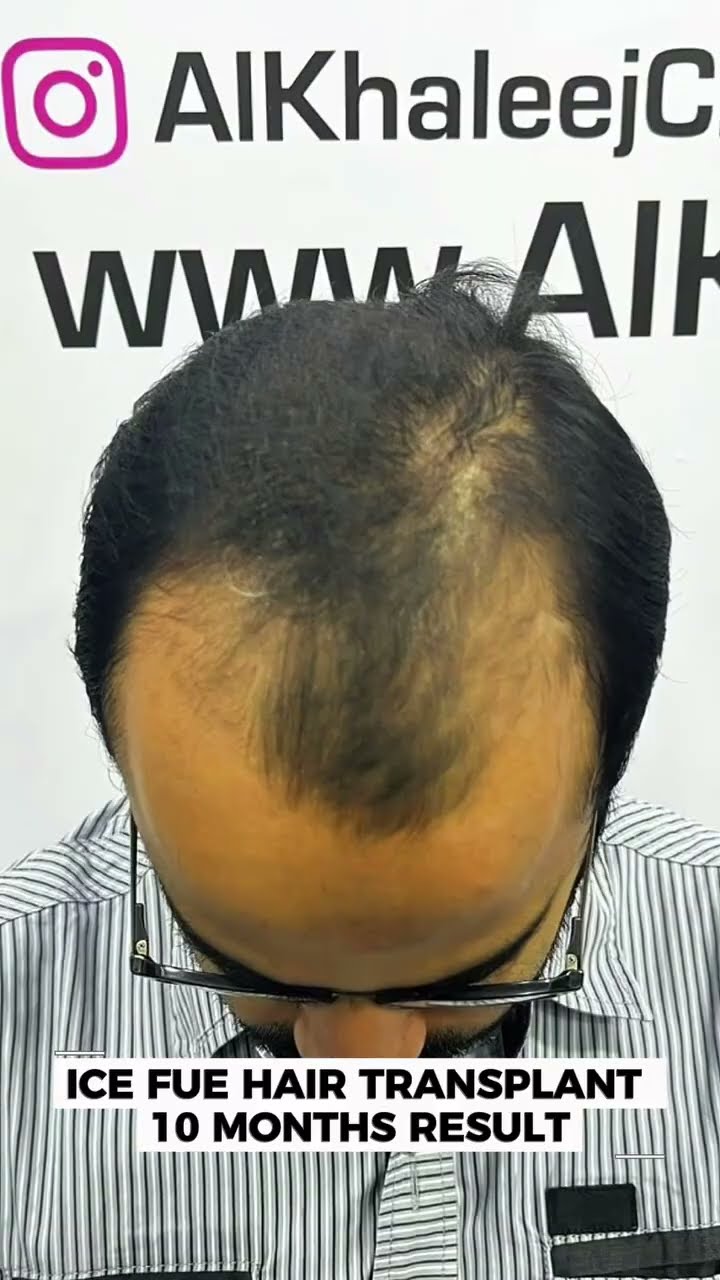 Diamond Sapphire technique for maximum density hair transplant - AlKhaleej Clinics
