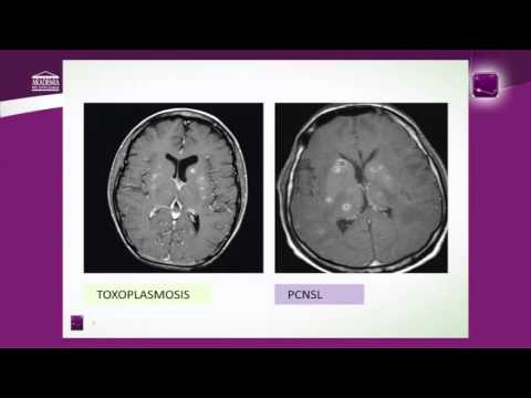 Chłoniaki ośrodkowego układu nerwowego