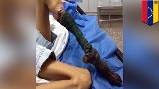 Укус змеи вызвал у девочки серьёзный случай некроза