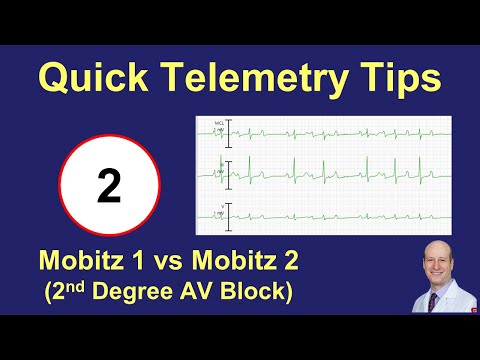 Telemetry Tips - 2nd Degree AV Block (Mobitz 1, Mobitz 2, and 2:1)