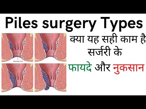 Laser surgery for piles fissure and fistula Laser treatment for piles fissure and fistula benefit