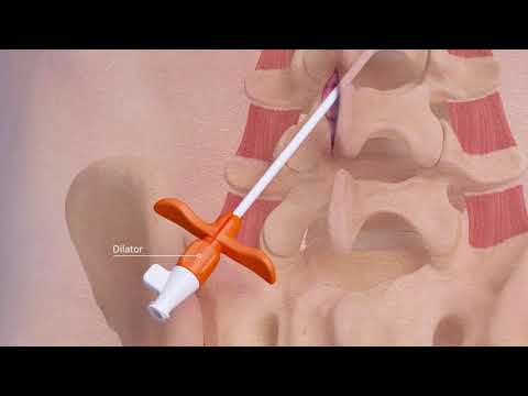 Dr. Georgios Matis - Neuromodulation - ReActiv8 implantation procedure