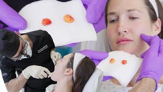 Buccal Fat Removal for Facial Contouring with Dr. Kian Karimi