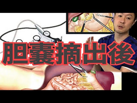 胆嚢手術 – 手術の概要、回復、リスク、ケア