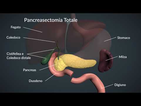 09 pancreasectomia totale
