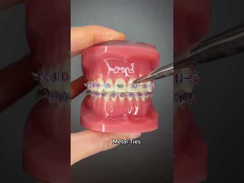 Different Types of Orthodontic Ties you can get at your Orthodontist Part 1