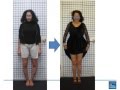 Dr Robert Rozbruch Bowleg Correction