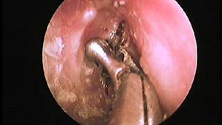 F B Insect in ear live removed by Endoscopy in Karn Hospital , Kolhapur by Dr Sandesh Bagadi
