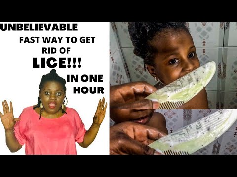 How to Get Rid of Head Lice in 1 Hour !!! (Very Simple Technique) #nigerianyoutuber #portharcourt