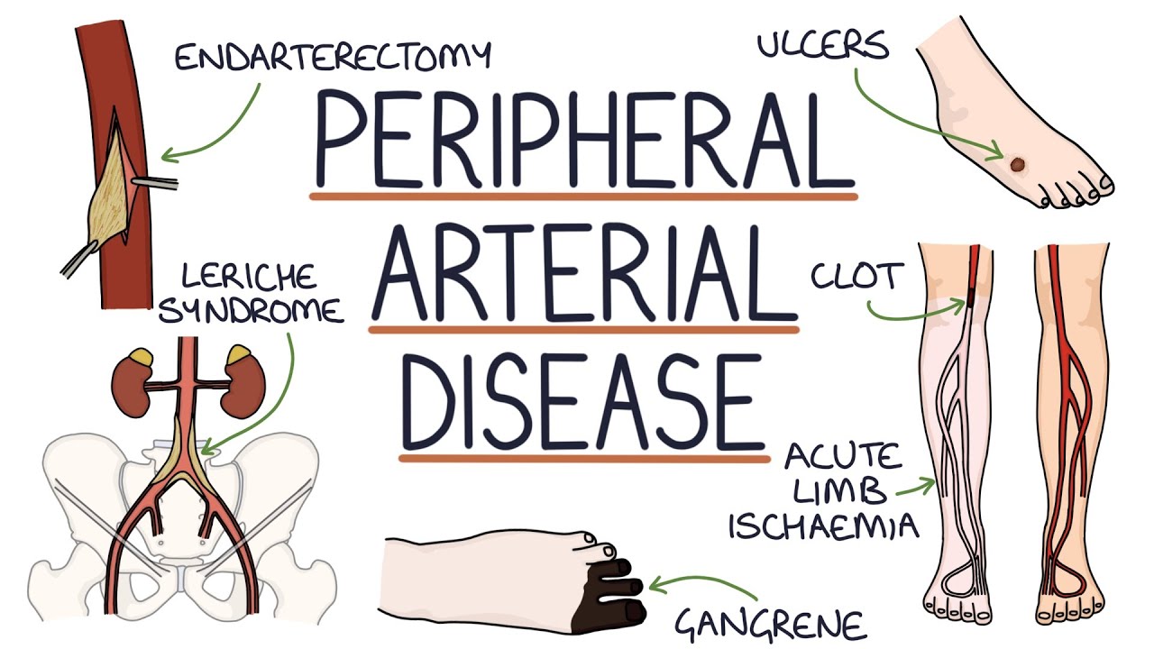 Understanding Peripheral Arterial Disease