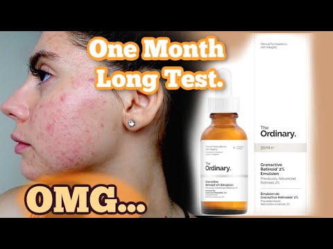 I TESTED THE ORDINARY RETINOID 2% EMULSION SERUM FOR MY ACNE SCARS ONE MONTH || Shocked by this..