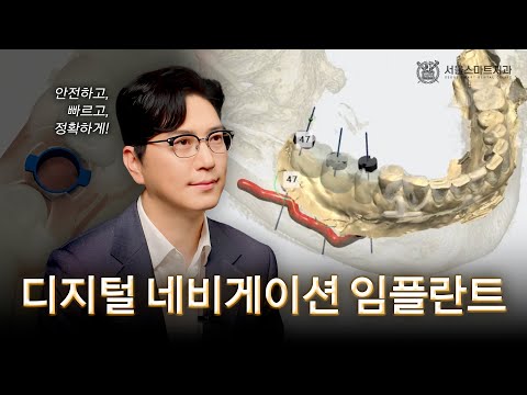 디지털 네비게이션 임플란트, 왜 요즘 더 많이 찾을까?