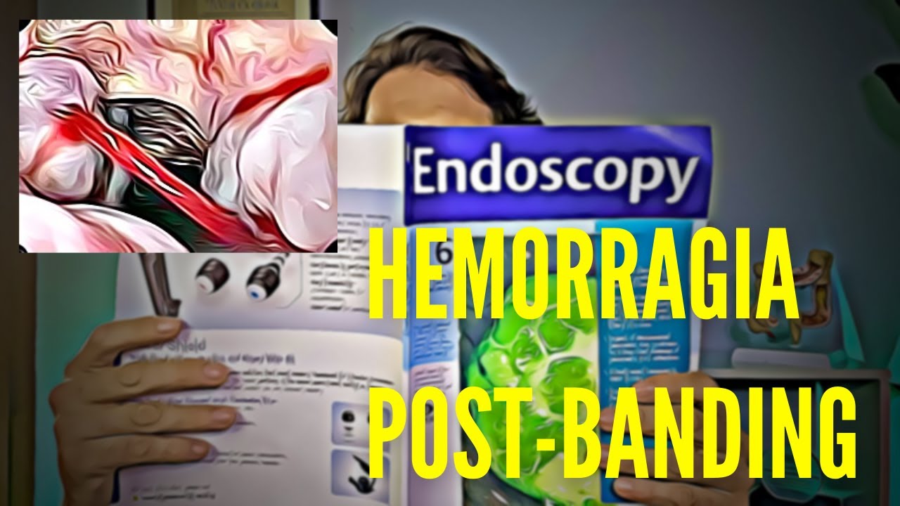 Watch 🚨 TODO lo que tienes que SABER de la HEMORRAGIA tras una ligadura de Varices esofágicas🚨. Now 🚨 TODO lo que tienes que SABER de la HEMORRAGIA tras una ligadura de Varices esofágicas🚨.