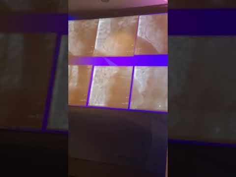 Tam tıkalı kalp damarlarının el bileğinden açılması