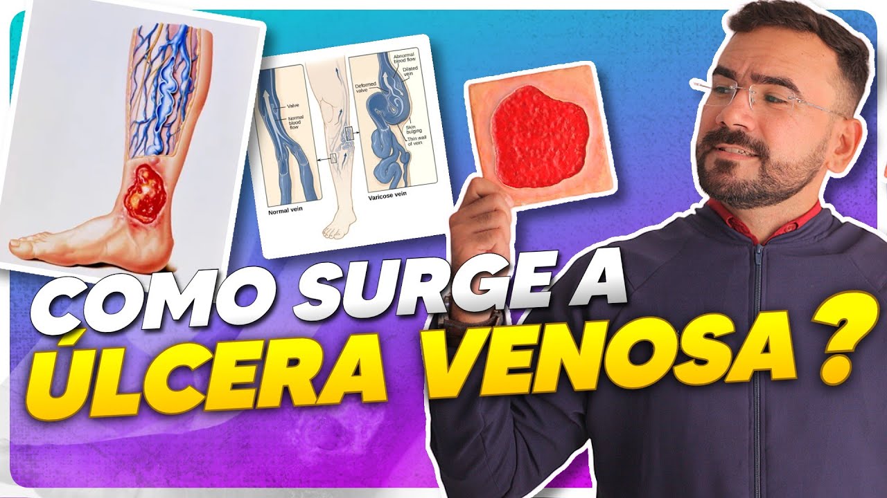 ÚLCERA VENOSA: CAUSA E TRATAMENTO DA ÚLCERA VARICOSA EM 2023