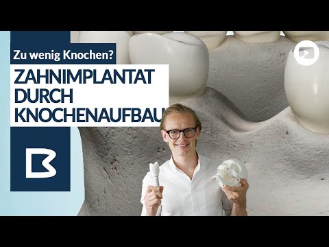 Knochenaufbau für Zahnimplantate - Alle Möglichkeiten genau erklärt!