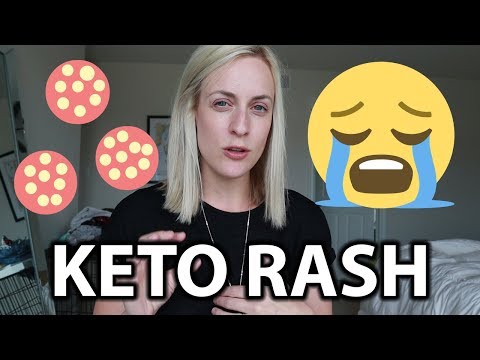 Cure for the Keto Rash
