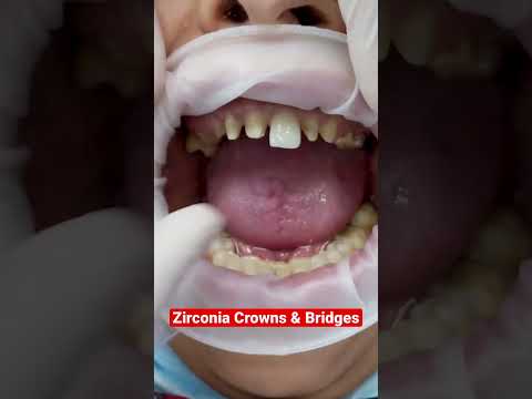 Zirconia Crowns and Bridges #shorts