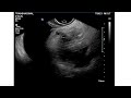 Sinais de ooforite pela ultrassonografia Dr Pixel