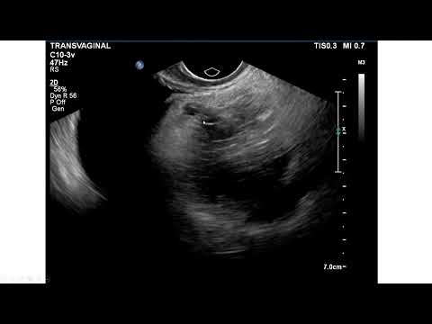 Teratoma ovariano. Sinal da ponta do iceberg.
