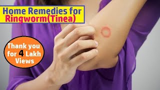 Ringworm (Tinea) - Natural Home Remedies