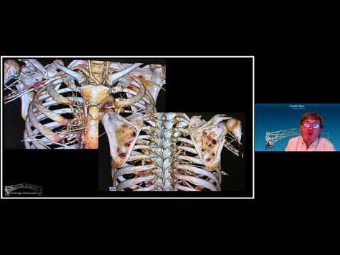 Scapula fractures overview
