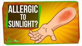 Can You Be Allergic To Sunlight?