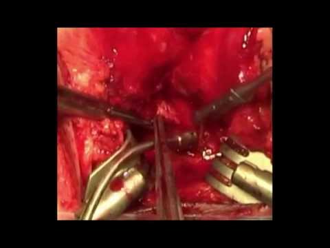 Prostate Cancer Radiation Treatment Related Urethral Strictures