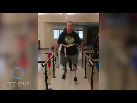 Motivated Bilateral Amputee Learns to Walk on His New Permanent Prostheses