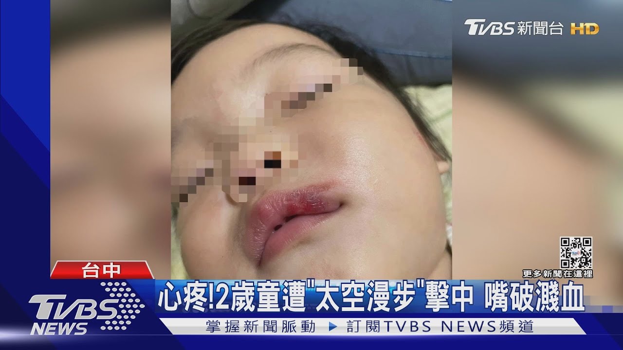 心疼！2歲童遭「太空漫步」擊中　嘴破濺血  