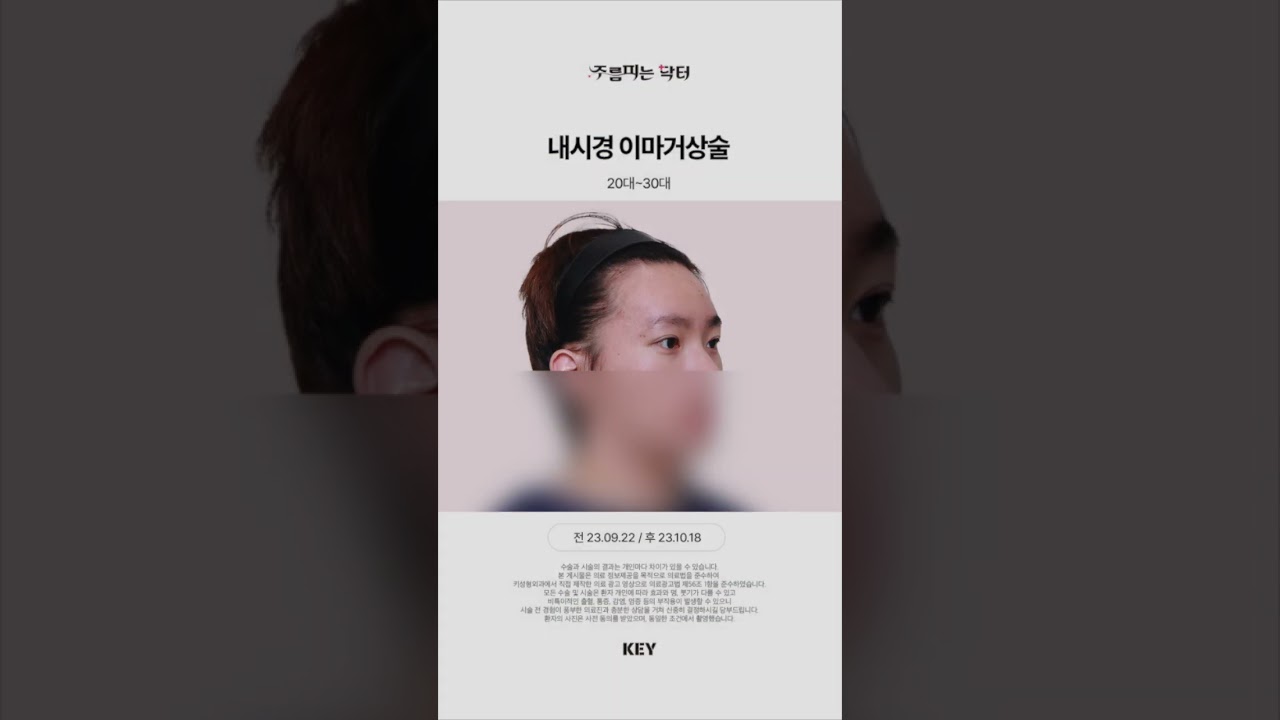 30대 이마거상 대구키성형외과