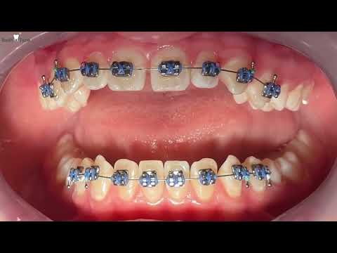 FULL Braces Placement!! Tooth Time Family Dentistry