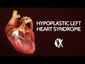 Hypoplastic Left Heart Syndrome (HLHS)