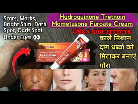 Hydroquinone Tretnoin Mometasone Furoate Cream || AAKARSHAN Cream || Use and side effects | in hindi