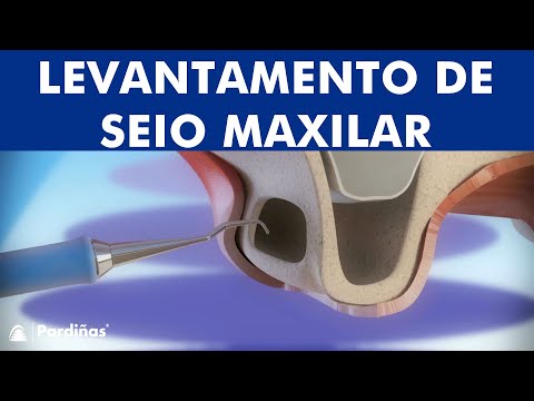 Levantamento de seio maxilar ©