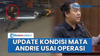 Andrie Yunus Jalani Rangkaian Operasi di RSCM, Terungkap Mata Masih Bisa Diselamatkan dan Tidak Buta