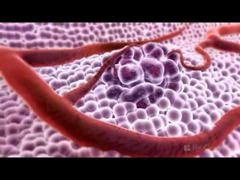 3D Medical Animation   What is Cancer
