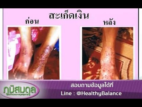 Guttate สะเก็ดเงินทำให้รุนแรงขึ้นการกำจัด โรคสะเก็ดเงินปรากฏตัวเป็น