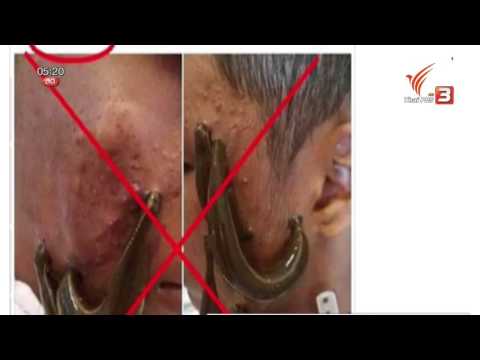 โรคสะเก็ดเงินป่าน โรคสะเก็ดเงินเป็นโรคติดต่อสำหรับการตั้งครรภ์