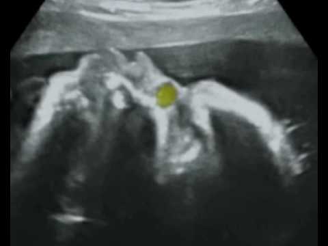 Fetal Medicine Foundation - Dacryocystocele