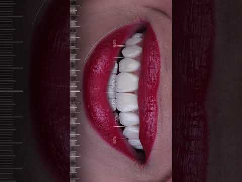 نتائج — ابتسامة هوليوود
