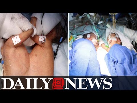 Conjoined Twins Separated at Just 8 Days Old