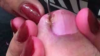 INGROWN CAUSE AND REMEDY | THE REAL PAIN OF PEDICURE