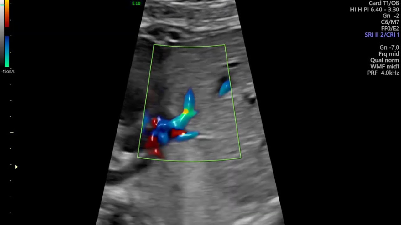 AVALIAÇÃO DE VEIA CAVA EM FETO DE 30 SEMANAS