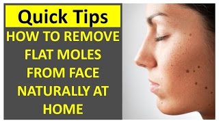 How to Remove Flat Moles from Face Naturally At Home